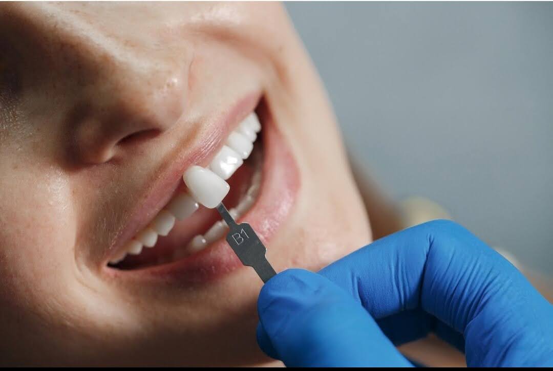 4 Signs You Need to Go for Dental Implants