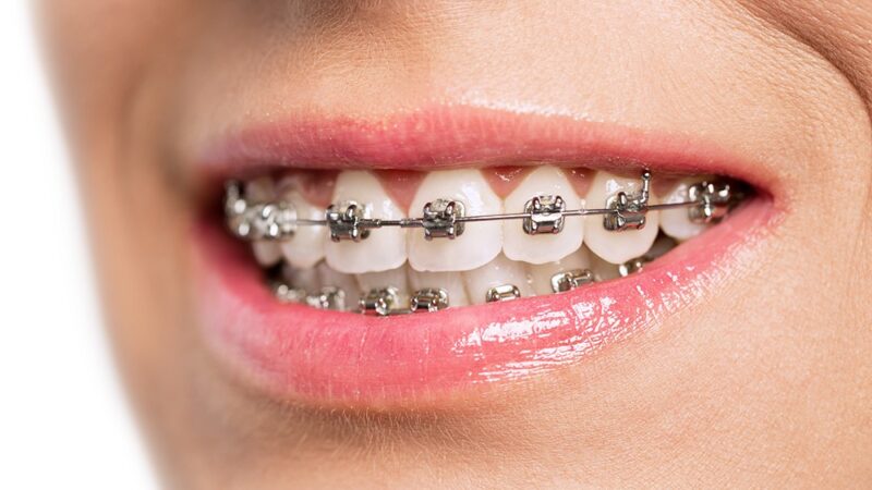 How Orthodontic Braces Can Straighten Crooked Teeth