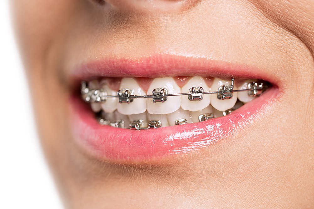 How Orthodontic Braces Can Straighten Crooked Teeth