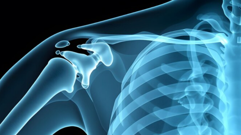 How Shoulder Replacement Surgery Can Help You Regain Pain-Free Arm Movement