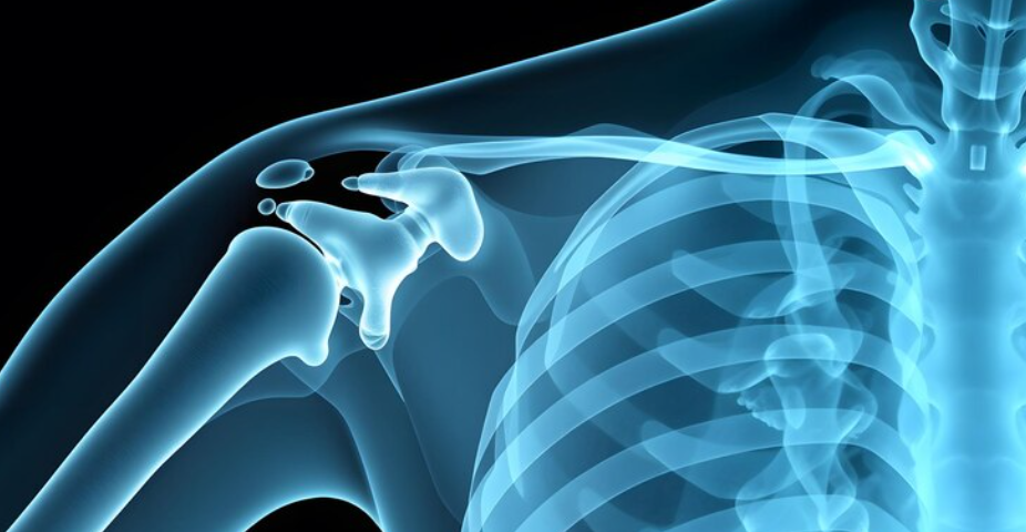How Shoulder Replacement Surgery Can Help You Regain Pain-Free Arm Movement